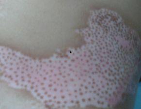 白癜风病人可吃哈密瓜吗,白癜风患者适宜食用哈密瓜吗？