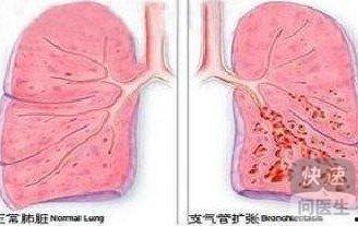 支气管扩张可以吃梨瓜吗